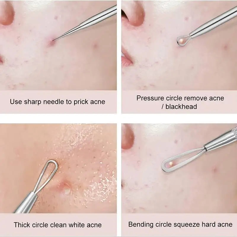 Juego de 4 piezas de agujas para acné y puntos negros